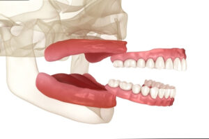 dentures cutting into gums