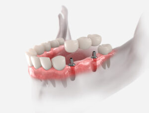 implant supported prothesis