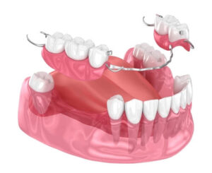 interim partials patient's dentition