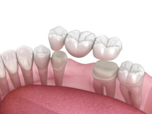 prosthetic teeth attached flipper tooth repaired